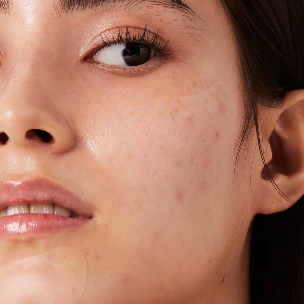 timeout blemish patch chin and cheeks - tea tree leaf acne patch - invisible acne patch for chin and cheeks