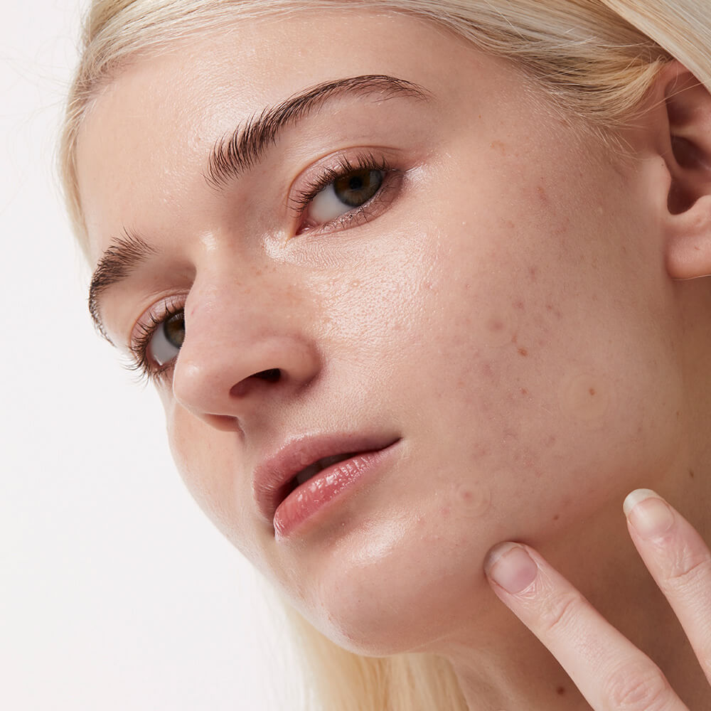 medium size acne patch - invisible blemish patch
