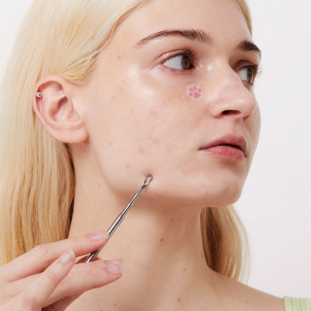 pimple popper - acne popper