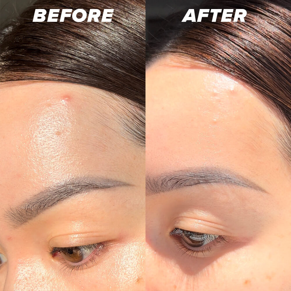before and after acne path